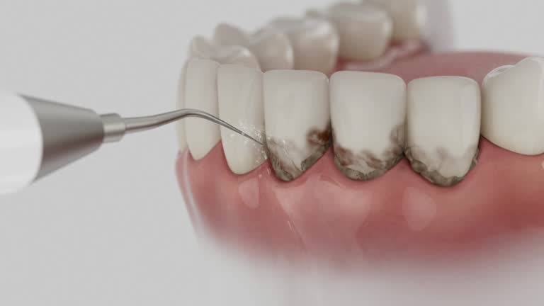 Trusted Teeth Cleaning And Checkup service in Mooresville, IN - Dentist Open Now